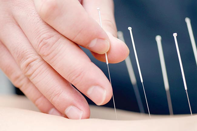 oriole acupuncture services