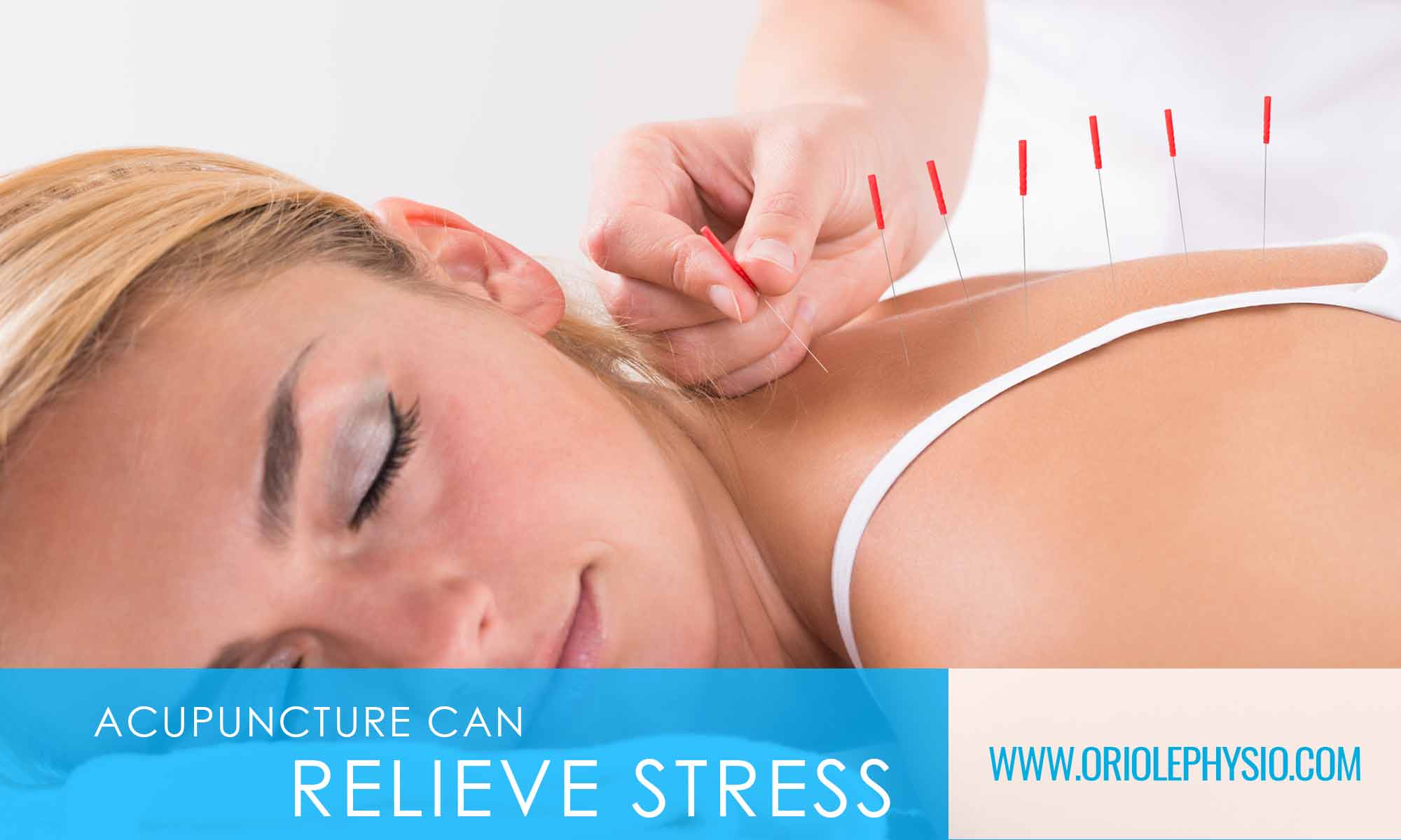 acupuncture can relieve stress