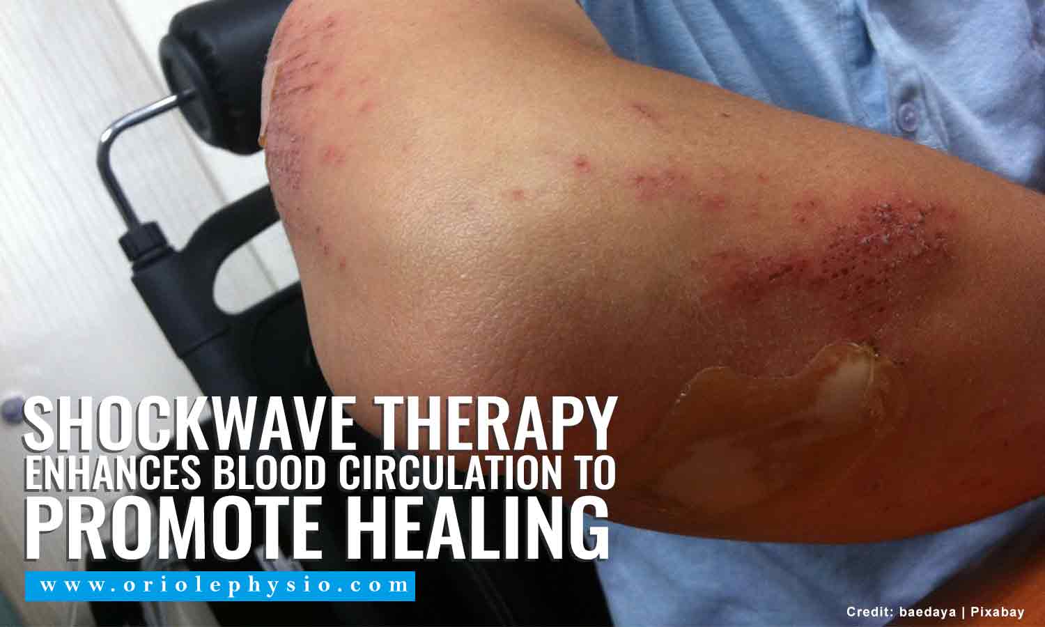 Shockwave therapy enhances blood circulation to promote healing