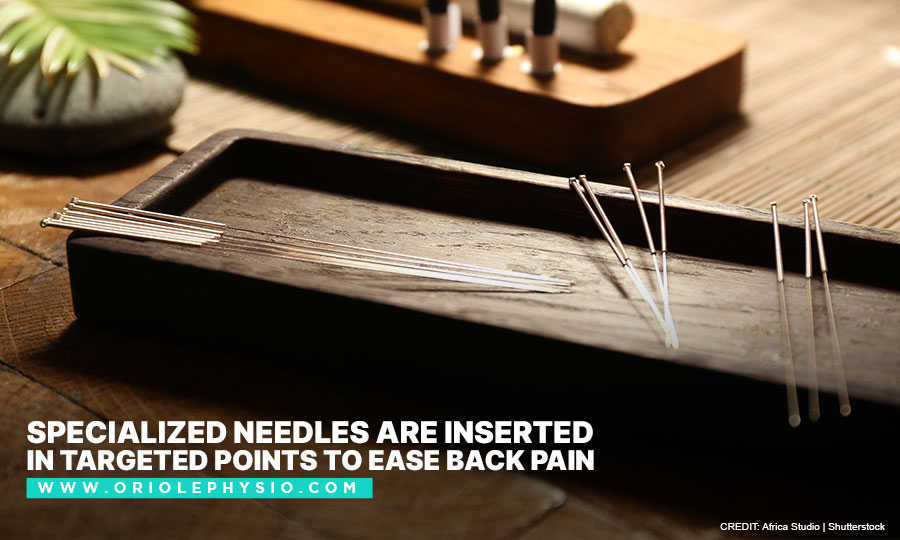 Specialized-needles-are-inserted-in-targeted-points-to-ease-back-pain
